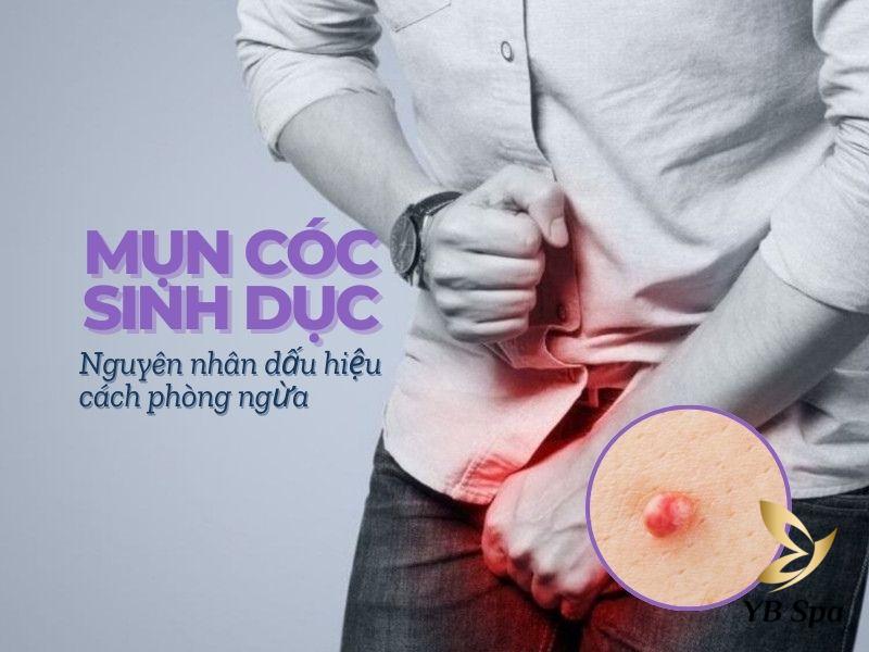 mụn cóc sinh dục