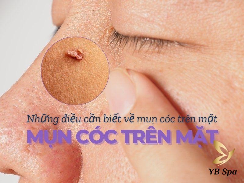 mụn cóc trên mặt