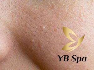 Mụn đầu trắng là gì? Nguyên nhân, dấu hiệu và cách điều trị