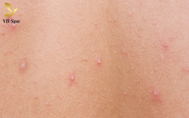 Mụn đầu trắng có nên nặn không? Cẩm nang điều trị và chăm sóc da chuẩn y khoa 23 Mụn đầu trắng có nên nặn không