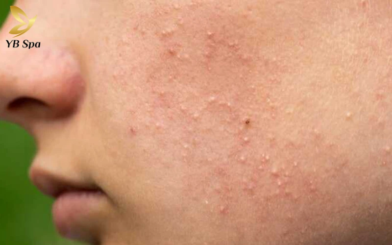 Mụn đầu trắng có nên nặn không? Cẩm nang điều trị và chăm sóc da chuẩn y khoa 24 Mụn đầu trắng là gì?