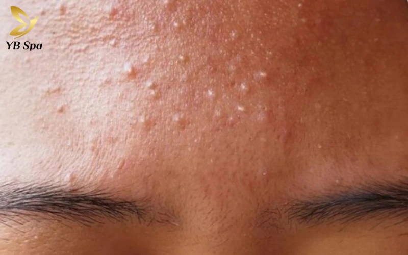 Mụn đầu trắng có nên nặn không? Cẩm nang điều trị và chăm sóc da chuẩn y khoa 25 Đặc điểm nhận dạng mụn đầu trắng