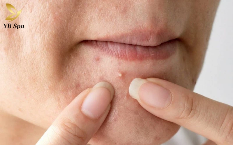 Mụn đầu trắng có nên nặn không? Cẩm nang điều trị và chăm sóc da chuẩn y khoa 26 Giải đáp: Mụn đầu trắng có nên nặn không?