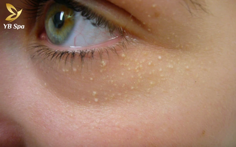 Mụn gạo có nặn được không? Giải đáp chuyên sâu từ chuyên gia 24 Mụn gạo là những hạt nhỏ chứa keratin nằm dưới da, không viêm nhưng rất khó tự biến mất.