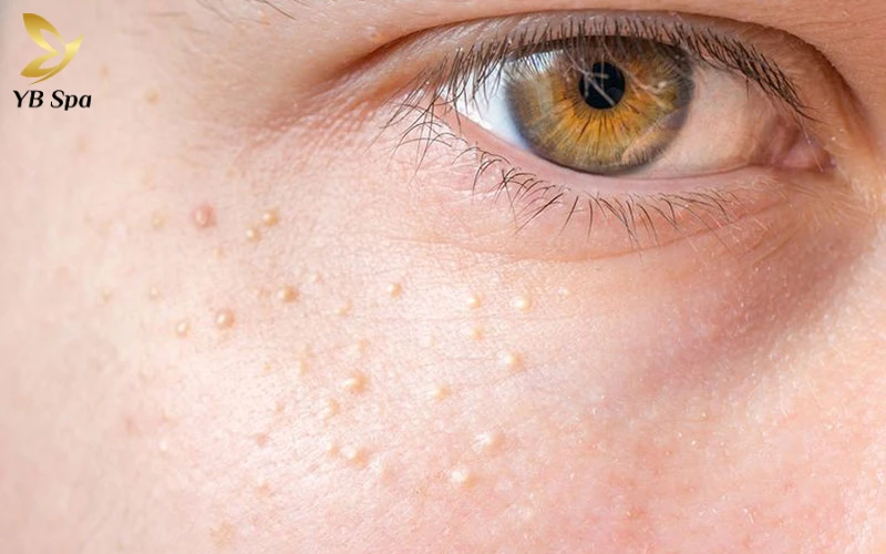 Mụn gạo có nặn được không? Giải đáp chuyên sâu từ chuyên gia 25 Mụn gạo không có đầu mụn nên việc tự nặn dễ gây thâm sẹo và viêm nhiễm.