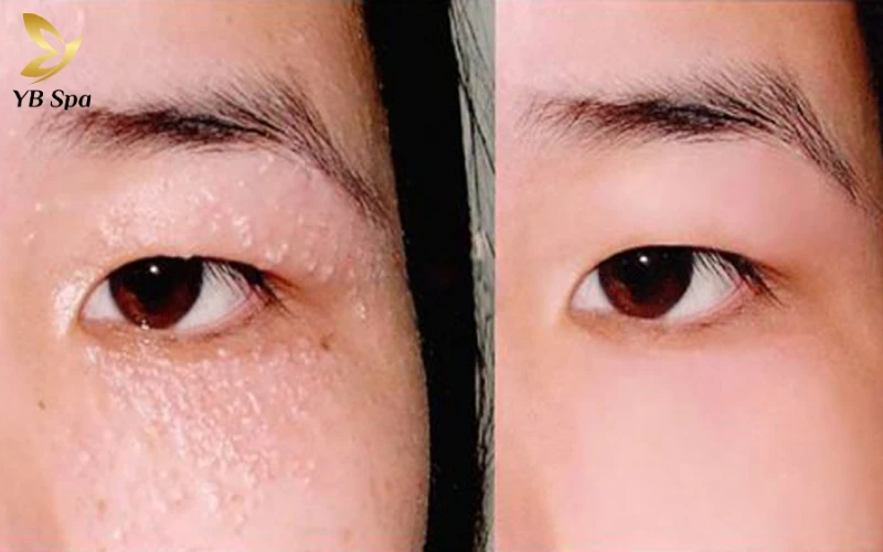 Mụn gạo có nặn được không? Giải đáp chuyên sâu từ chuyên gia 29 Can thiệp mụn gạo phải được thực hiện bởi chuyên gia da liễu, không tự làm tại nhà.