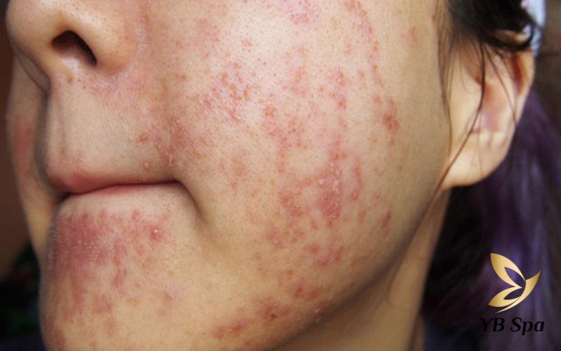 Mụn mọc quanh miệng do đâu? Cách điều trị hiệu quả 19 Sử dụng các sản phẩm kém chất lượng, không phù hợp với loại da hoặc tình trạng da hay sử dụng không đúng cách cũng sẽ khiến da bị kích ứng