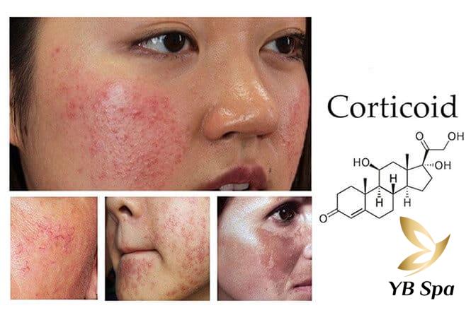 Mụn mọc quanh miệng do đâu? Cách điều trị hiệu quả 20 Việc lạm dụng những sản phẩm này hoặc sử dụng trong thời gian dài sẽ gây mỏng da, phá hủy hàng rào bảo vệ da