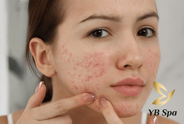 Mụn mọc quanh miệng do đâu? Cách điều trị hiệu quả 21 Tự ý nặn mụn sẽ khiến cho da của bạn trở nên sần sùi, thâm sạm và khiến mụn bị viêm trầm trọng hơn