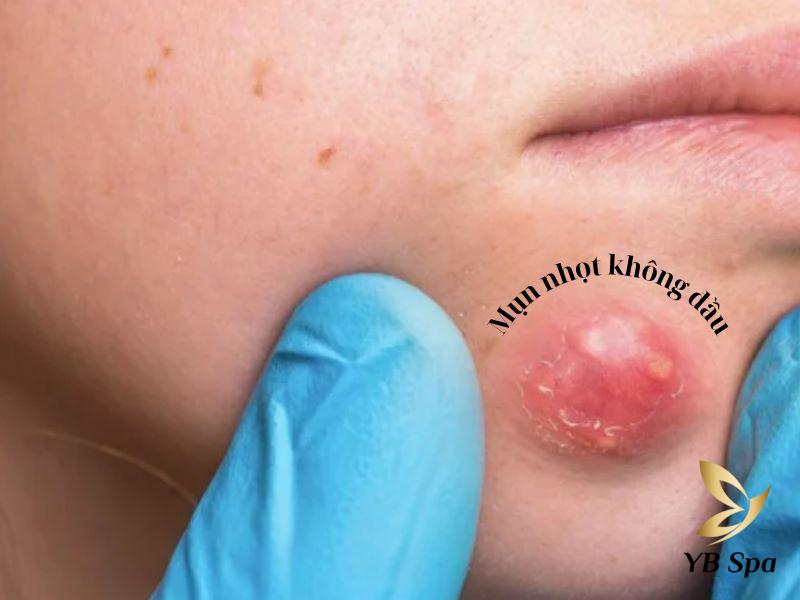 mụn nhọt không có đầu