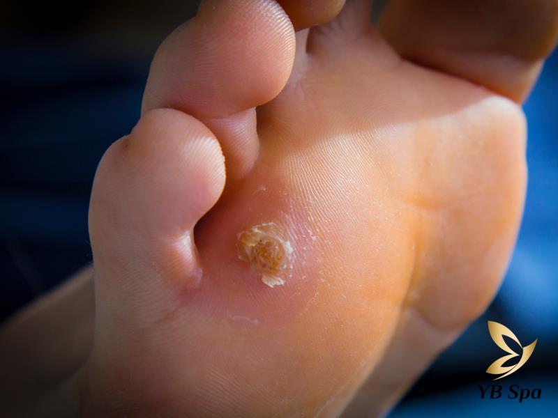 Mụn nhọt mọc ở dưới bàn chân