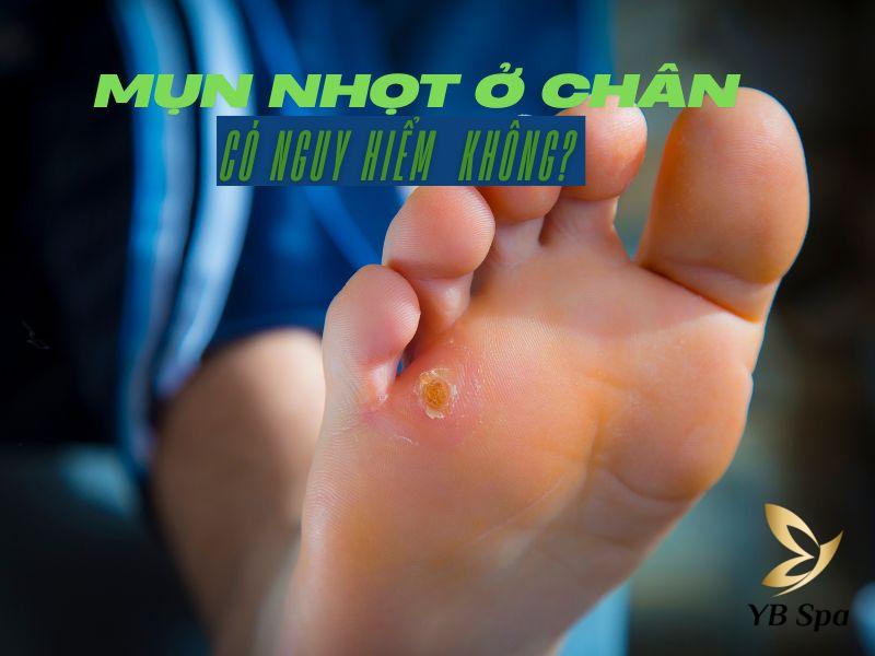 mụn nhọt ở chân