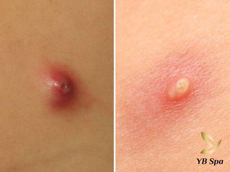 Mụn nhọt đang viêm và có mủ