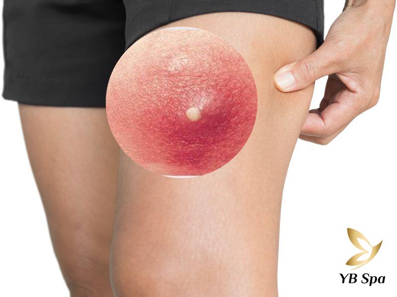 Mụn nhọt ở đùi đang bị viêm