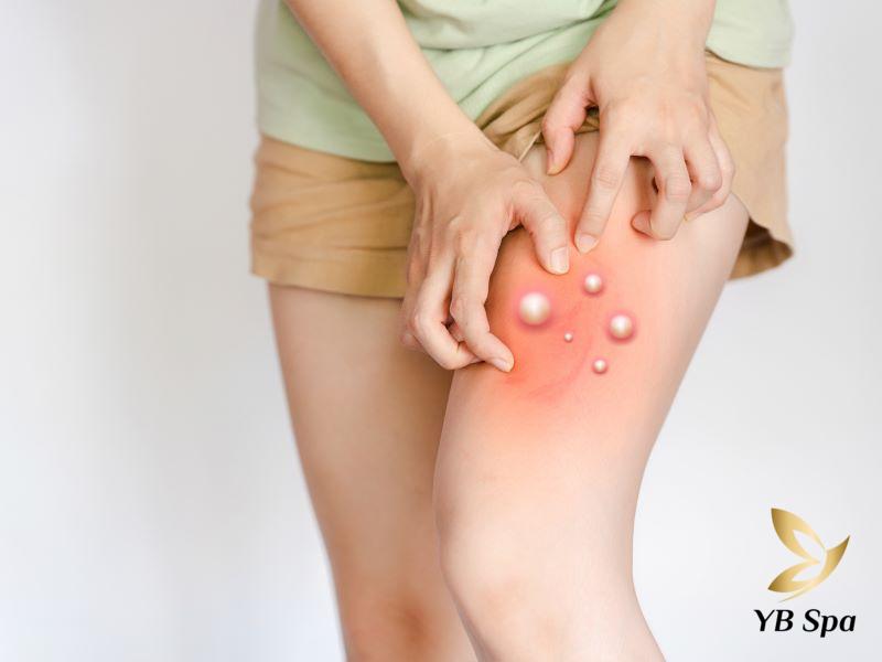 Mụn nhọt ở đùi gây đau đớn