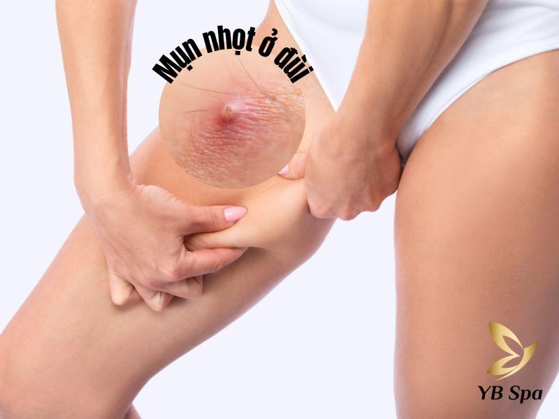 mụn nhọt ở đùi