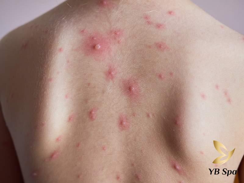 mụn nhọt ở lưng