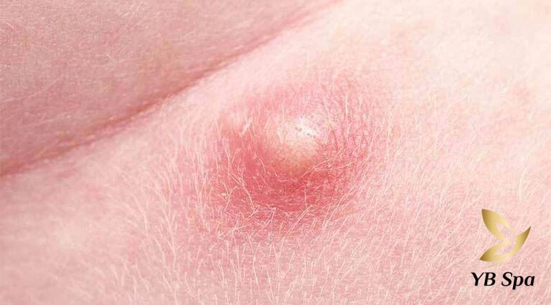 Mụn nhọt bị chai cứng