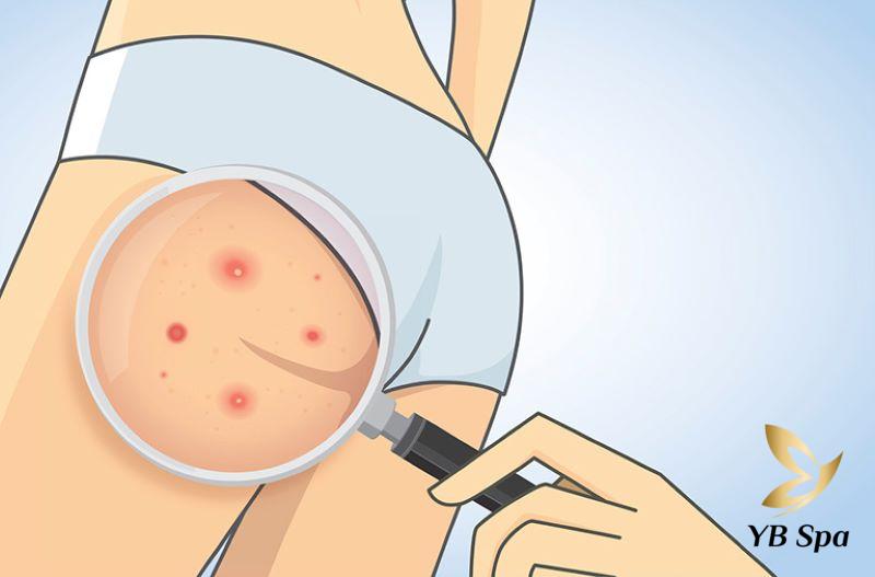 Mụn nhọt ở vị trí mông