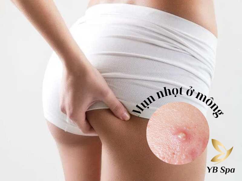 Mụn nhọt ở mông bị viêm mủ