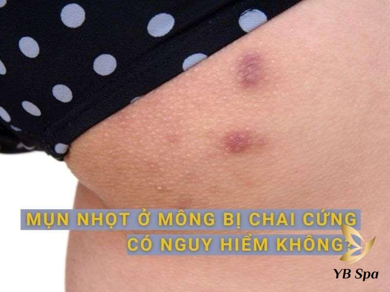 mun nhot o mong bi chai cung​