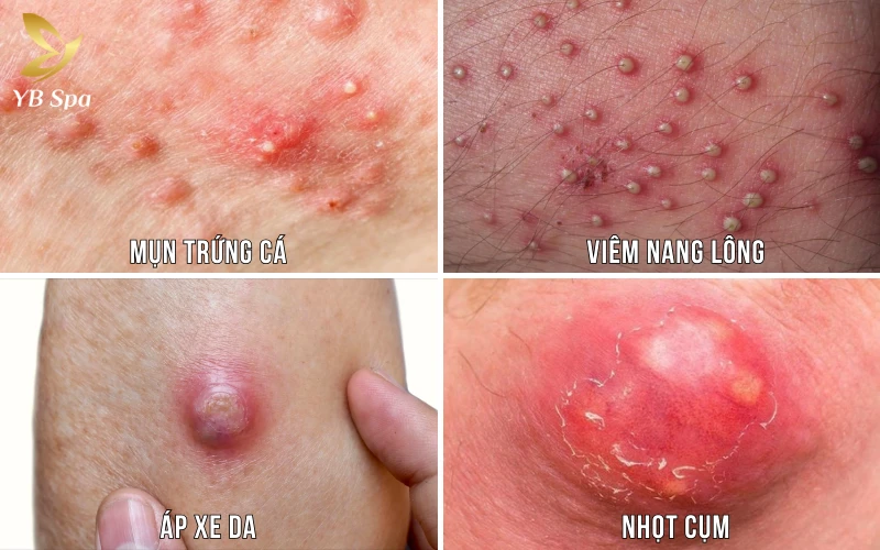 Phân biệt mụn nhọt với các bệnh lý viêm da khác