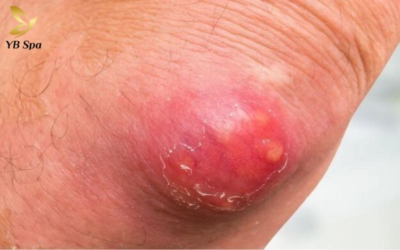 Khi nào mụn nhọt trở nên nguy hiểm?