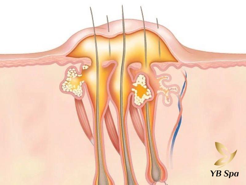 Hình ảnh mô phỏng tình trạng mụn nhọt trong lỗ tai