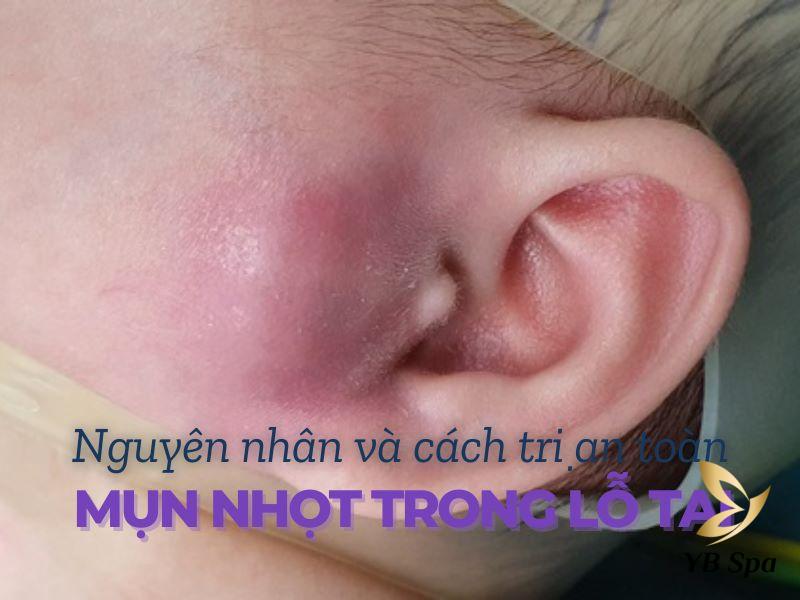 mụn nhọt trong lỗ tai​