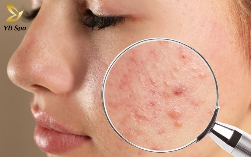 Mụn nội tiết có chữa được không? Cách trị mụn nội tiết hiệu quả 19 Ảnh minh họa: Mụn nội tiết