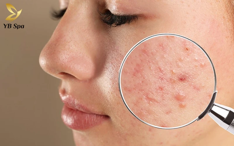 Mụn nội tiết tố