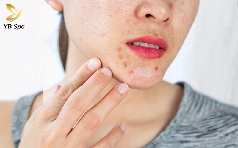 Mụn nội tiết thường xuất hiện ở vùng cằm – hàm