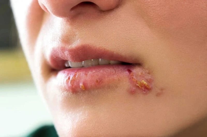 Mụn nước ở môi: Các lưu ý và cách trị môi bị nổi mụn nước 4 Mụn nước ở môi