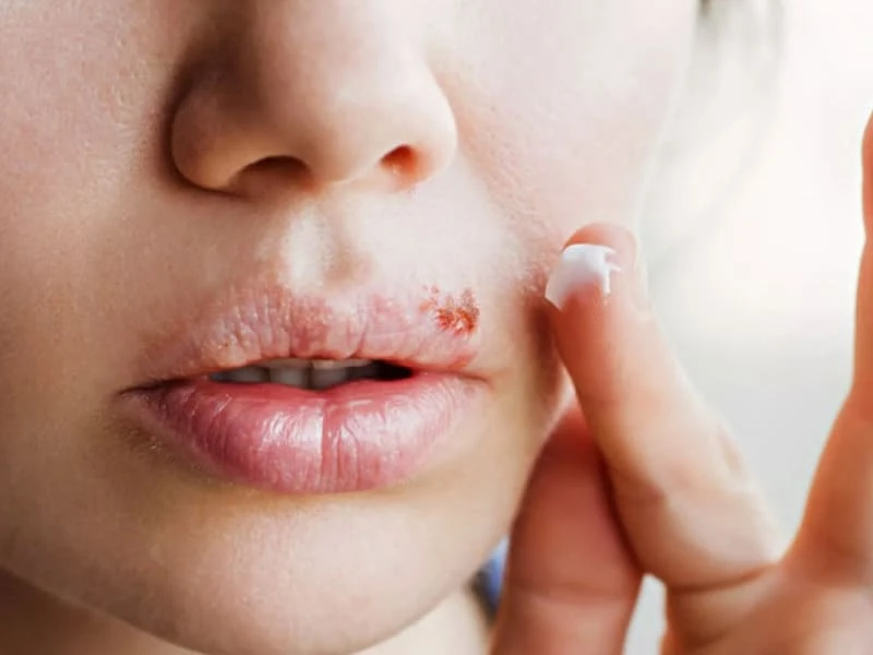Mụn nước ở môi: Các lưu ý và cách trị môi bị nổi mụn nước