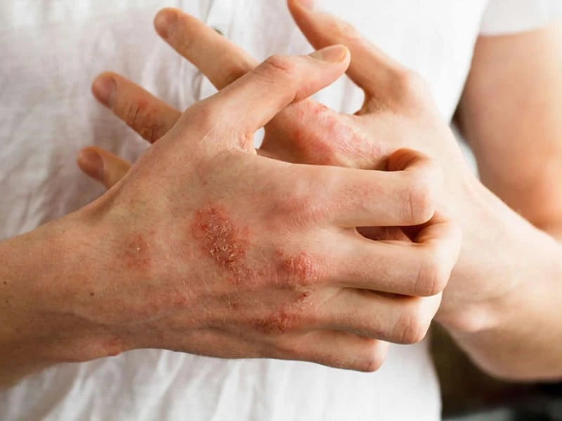 Mụn nước ở tay: Nguyên nhân và cách trị hiệu quả, an toàn 4 Mụn nước ở tay gây viêm ngứa