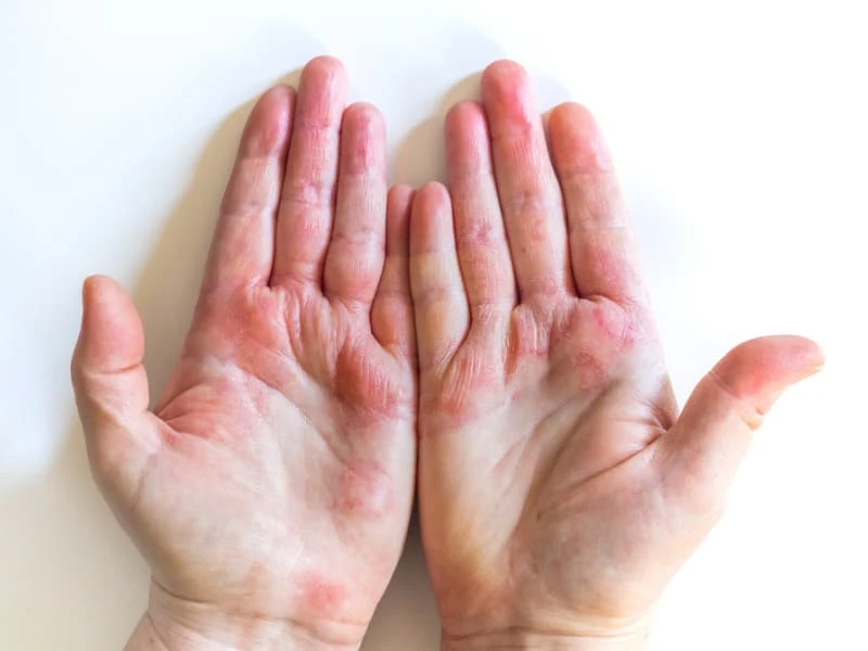 Mụn nước ở tay: Nguyên nhân và cách trị hiệu quả, an toàn