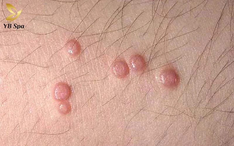 Mụn Cóc Sinh Dục (Condyloma Acuminata) - Mụn Ở Bộ Phận Sinh Dục Nam