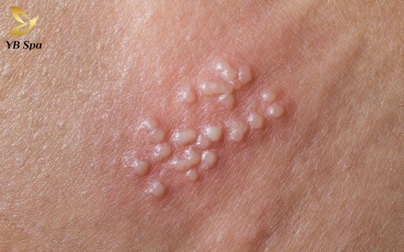 Mụn Trắng Trên Bao Quy Đầu - Mụn Ở Bộ Phận Sinh Dục Nam