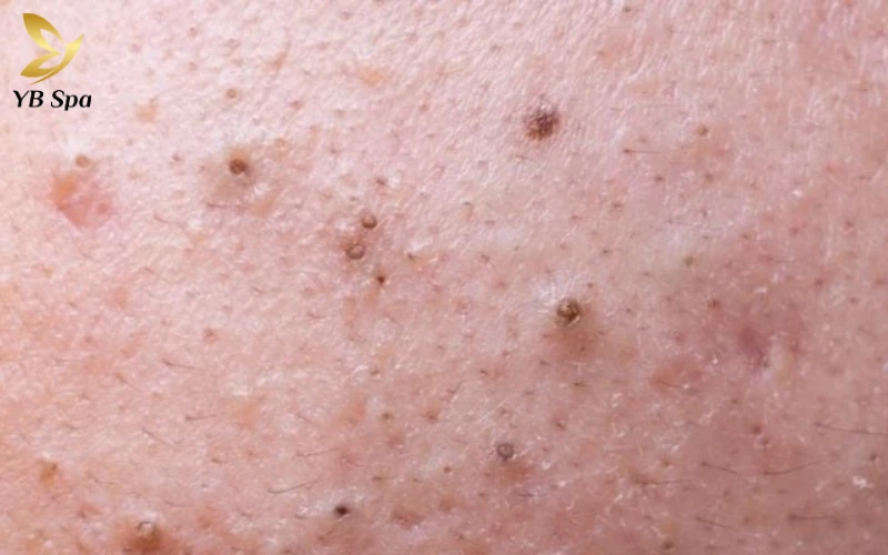 Mụn Ẩn, Mụn Đầu Đen Ở Vùng Kín Nam