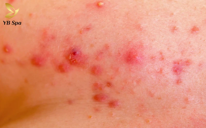 Mụn Đỏ Ở Vùng Tinh Hoàn