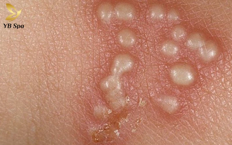 Mụn Nước (Herpes Sinh Dục)