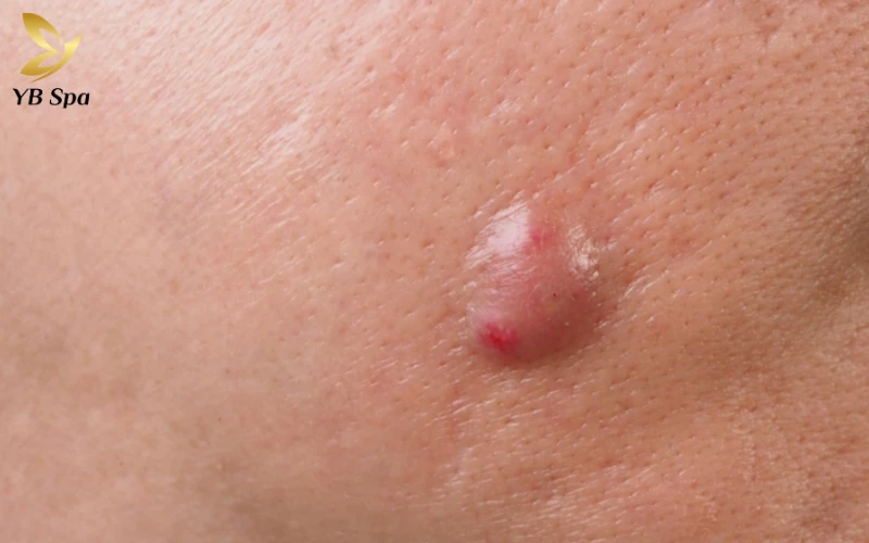 Mụn Nang Bã Nhờn (Sebaceous Cyst)