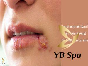 Mụn ở mép môi là gì? Nguy hiểm không? Cách điều trị tại nhà