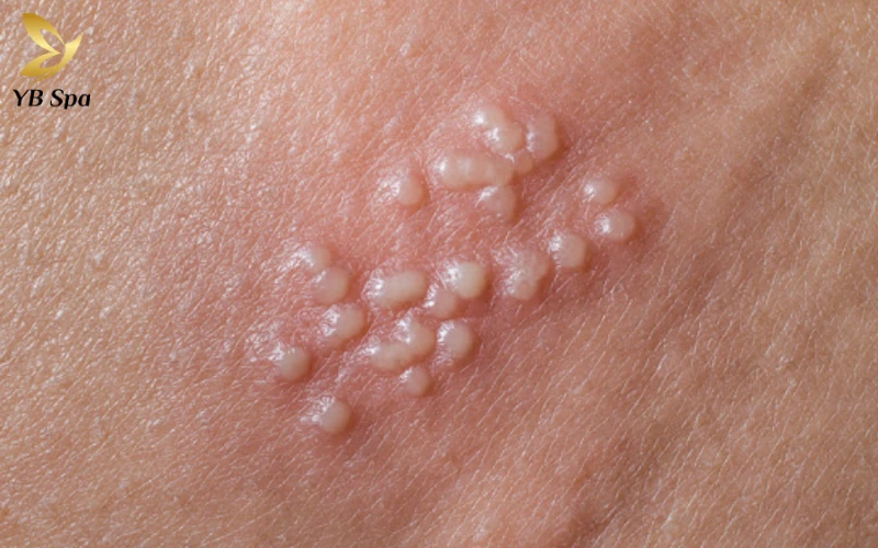 Mụn rộp sinh dục là gì? Triệu chứng, nguyên nhân và hướng dẫn điều trị 21 Mụn rộp sinh dục là gì