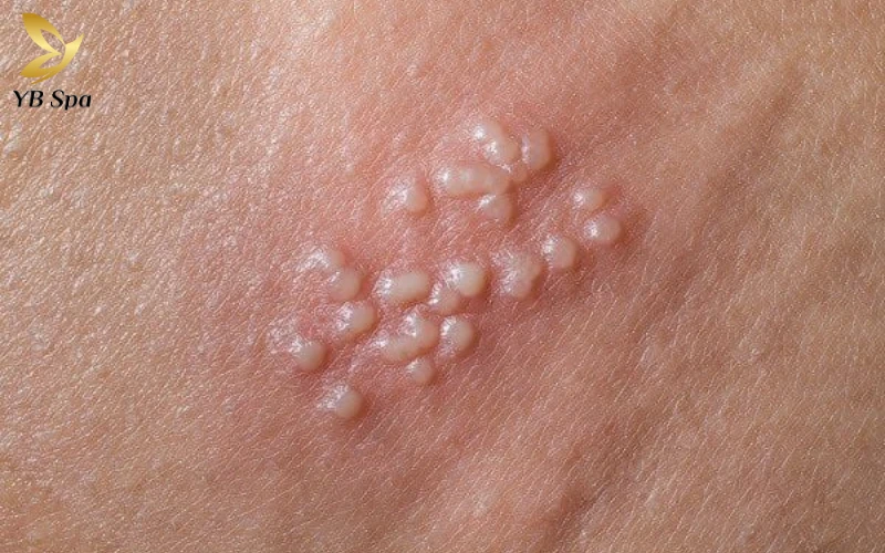 Mụn rộp sinh dục có tự khỏi không