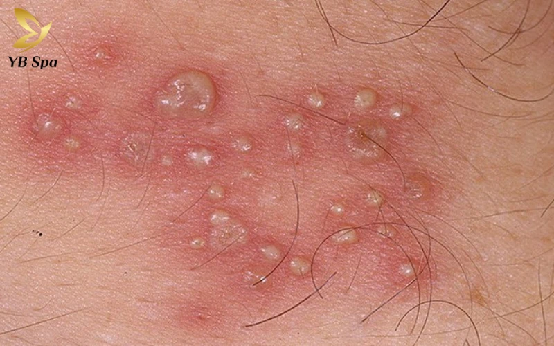 Mụn rộp sinh dục có tự khỏi không?