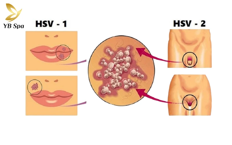 Phân biệt mụn rộp sinh dục và mụn rộp miệng
