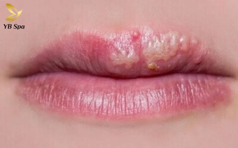 Giai đoạn bùng phát mụn nước