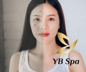 Mụn thâm tụ máu là gì? Nguyên nhân và cách điều trị