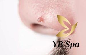 Mụn thịt ở mũi là là các khối u nhỏ lành tính xuất hiện trên da